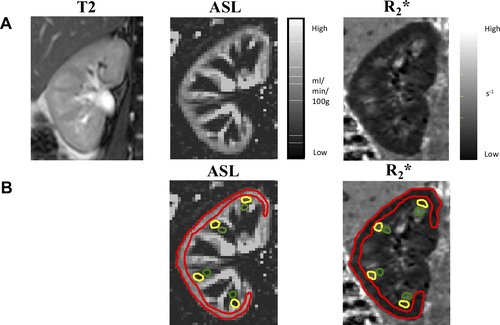 Newswise: Noninvasive Imaging Effectively Shows Variations in Renal Blood Flow